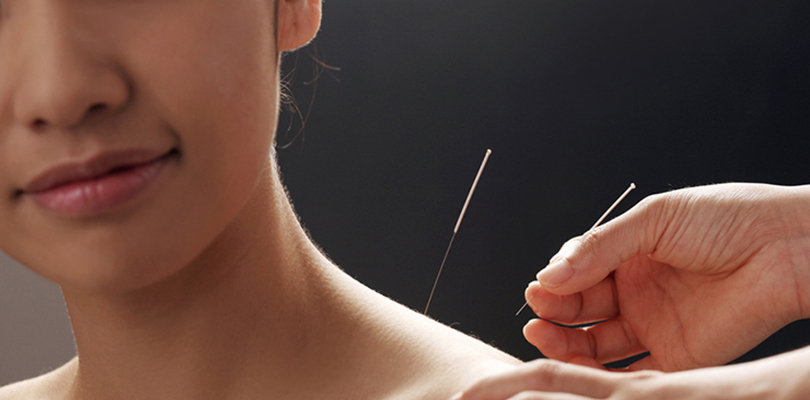 Woman is receiving acupuncture