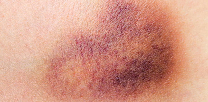 A large bruise appears on a person's body