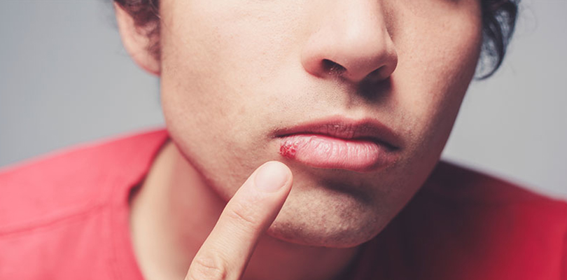 A young man is pointing at the cold sore on his lip