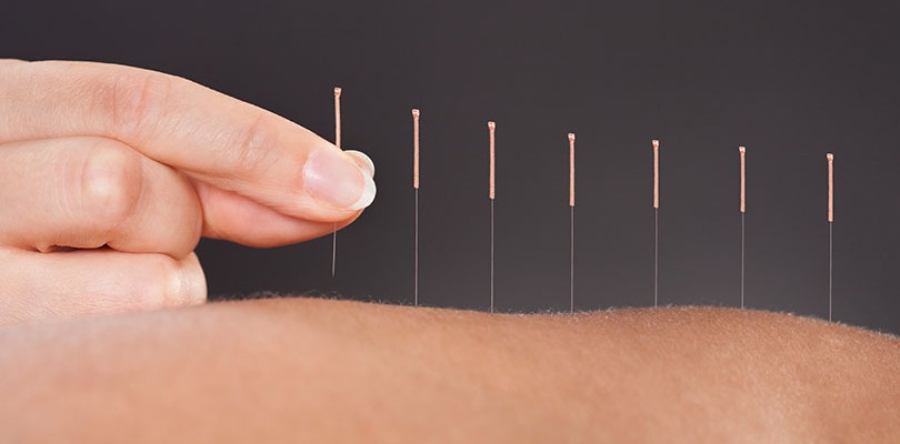 Try Acupuncture