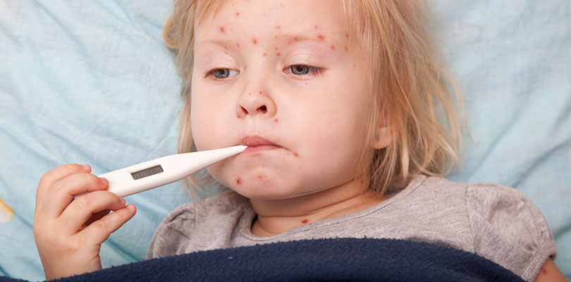 A child with chickenpox holds a thermometer in mouth