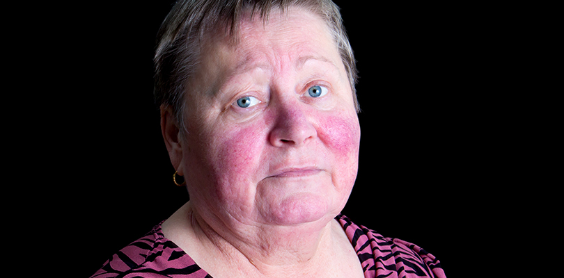 Mature woman with rosacea on her face