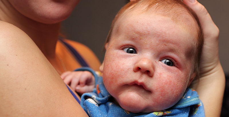 A child with eczema is being held by his or her mother
