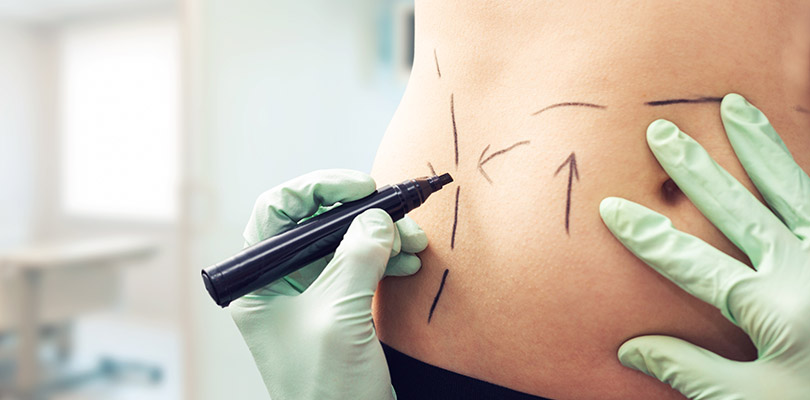 A plastic surgeon draws on an individual's stomach before surgery