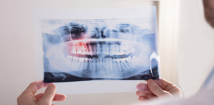 A x-ray of wisdom teeth