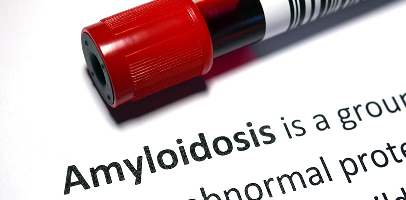 A blood sample with the definition of amyloidosis