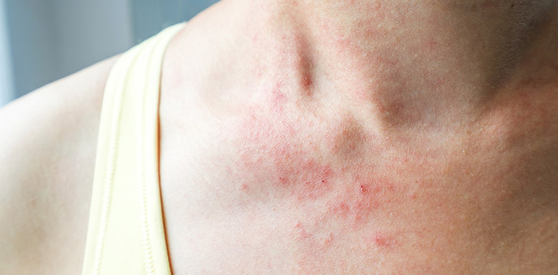 Eczema on an individual's collarbones