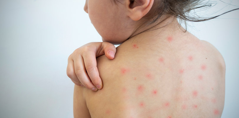 Child with measles rash on back