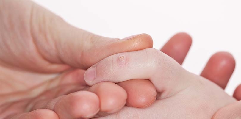 A wart on a person's finger.